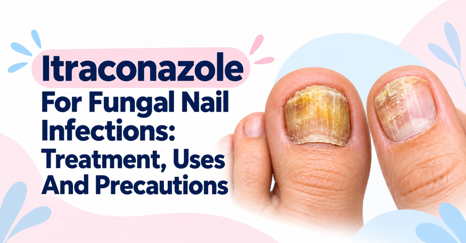 Itraconazole For Fungal Nail Infections: Treatment, Uses And Precautions